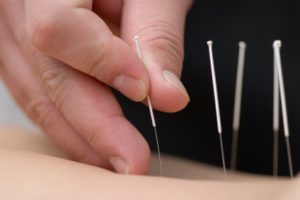 Treatment by acupuncture.
